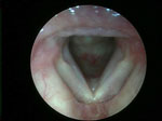 Figure 2 : Infraglottic edema: a finding highly sensitive but not specific for laryngopharyngeal reflux (LPR). Unfortunately we are unable to provide accessible alternative text for this. If you require assistance to access this image, or to obtain a text description, please contact npg@nature.com