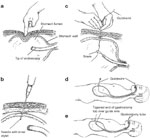 Percutaneous Enteral Gastrostomy