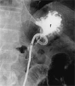 Figure 17 : Radiograph of a Cope loop gastrostomy tube in position within the stomach. Unfortunately we are unable to provide accessible alternative text for this. If you require assistance to access this image, or to obtain a text description, please contact npg@nature.com