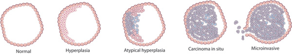 A schematic diagram shows five different images of a group of cells, depicting the various stages that occur in the progression from normal, healthy cells to invasive cancer cells. Normal cells in the population are shown as light pink circles with a darker pink border and a darker pink dot in their center; they are arranged side-by-side to form a hollow ring. Hyper-proliferating, mutant cells are shown as light purple circles with a darker purple border, some of which have a dark purple dot in their center, or as blue cells. The mutant cells are shown dividing inside the ring of healthy cells where they form a dense clump that eventually fills the inside of the ring, rupturing it.