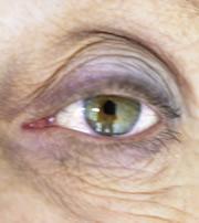 RNA therapy could help to combat macular degeneration.