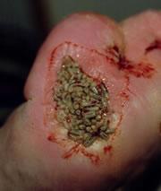 It looks bad, but it works: maggots can clean out some foot wounds better than drugs.