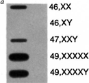 This slot blot shows bands of varying intensity that represent the relative amount of Xist RNA in samples of total RNA prepared from several cell lines. There is a band representing Xist expression in normal (46, XX) females, but there is no band in normal males (46, XY). The intensity of Xist expression in the 47, XXY, the 49, XXXXX, and the 49, XXXXY aneuploid cell lines is proportional to the number of supernumerary X chromosomes. The band is less intense in 47,XXY than 46,XX but more intense in 49,XXXXX and 49, XXXXY.