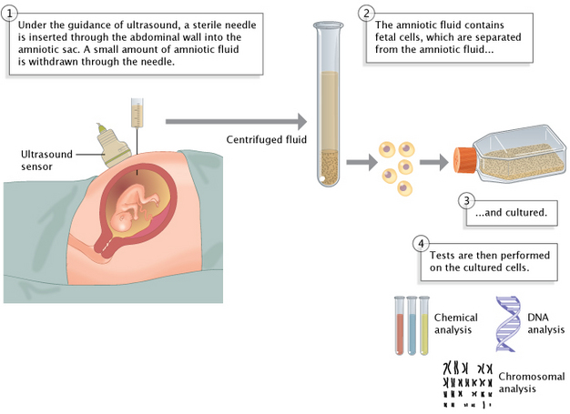 An illustrated diagram shows the amniocentesis procedure in four stages. Textboxes along with illustrations describe each step in detail, including sample collection from the amniotic fluid of a developing fetus; separation of fetal cells from the fluid; culture of fetal cells; and chemical, DNA, and chromosomal analysis of the cells.